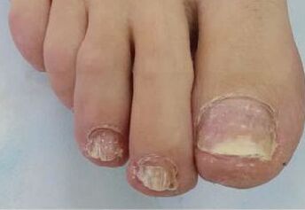 Mycosis of the nails was a problem