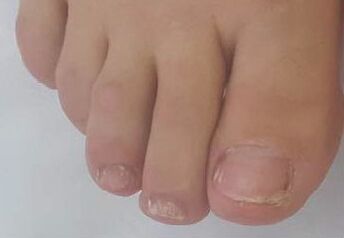 Promicil treated advanced onychomycosis