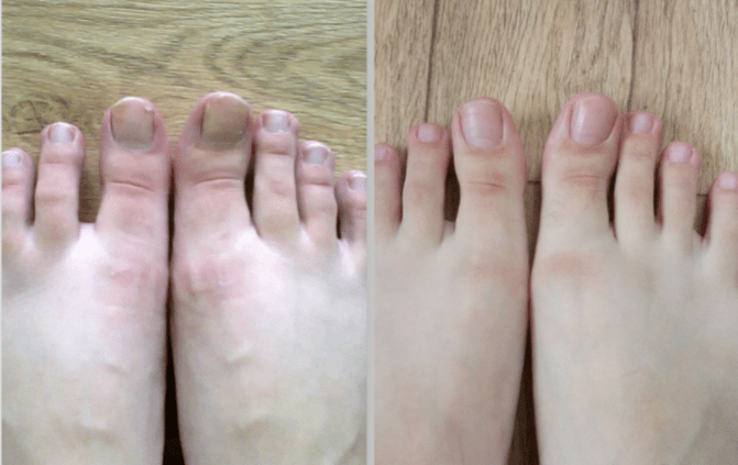 before and after treatment for nail fungus