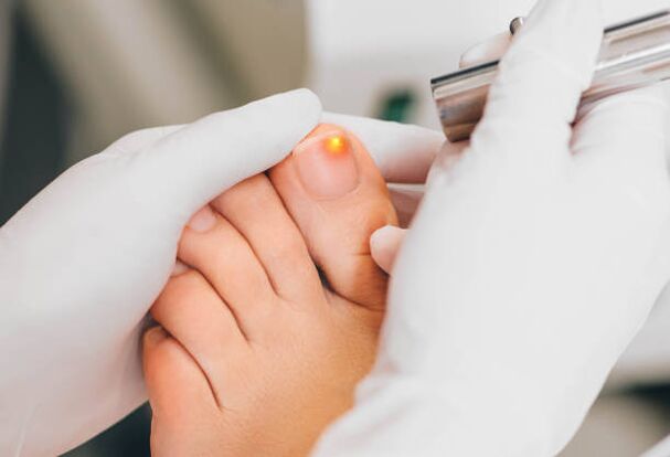 laser treatment of toenail fungus