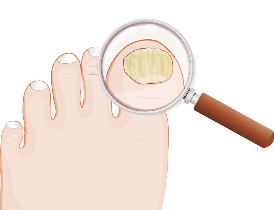 signs of nail fungus