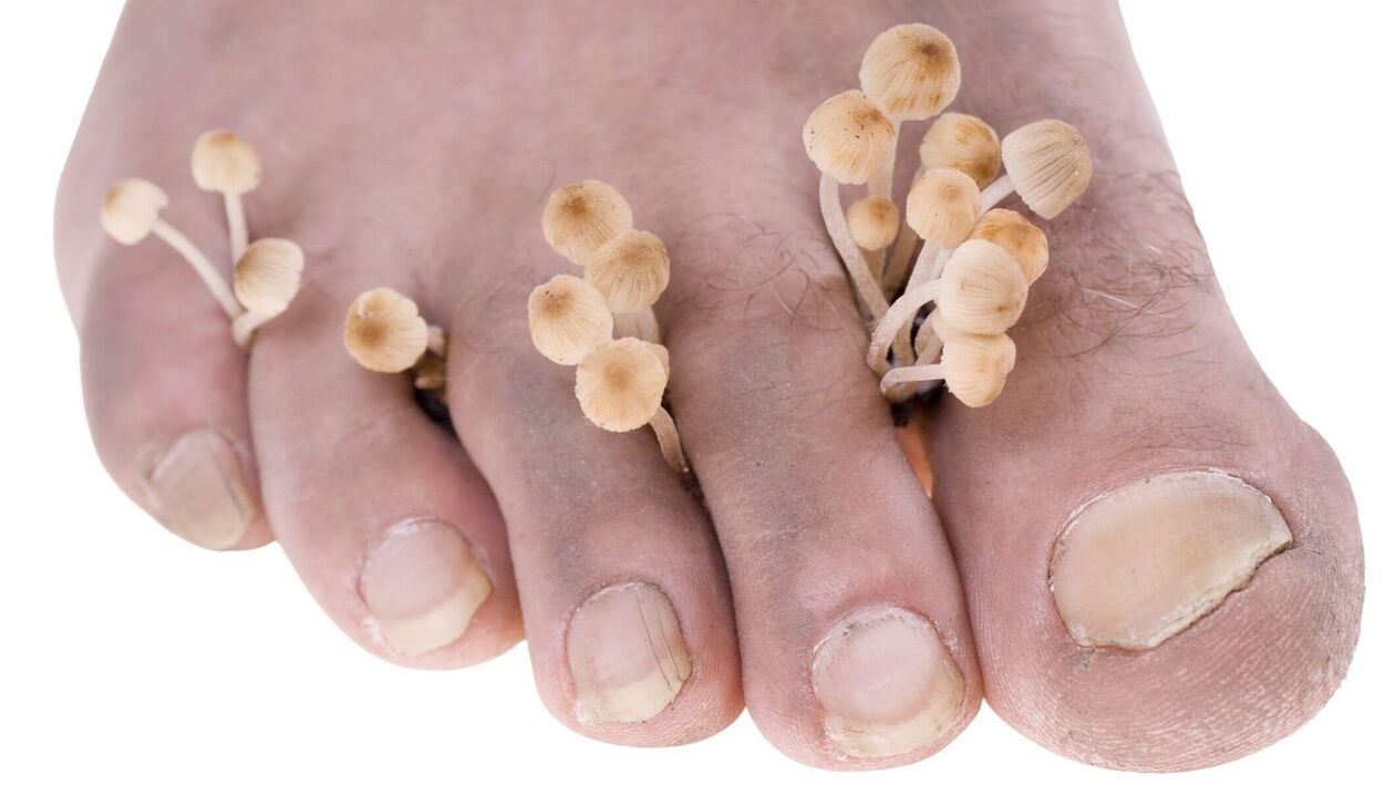 fungal infection of the human foot