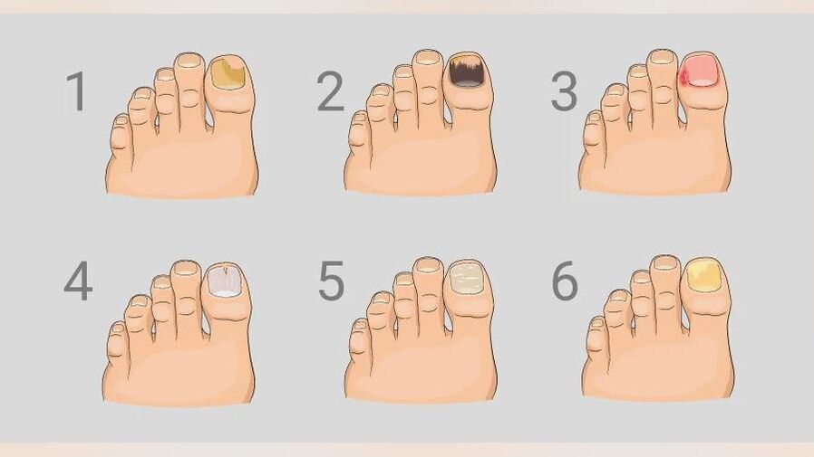 the main symptoms of foot fungus