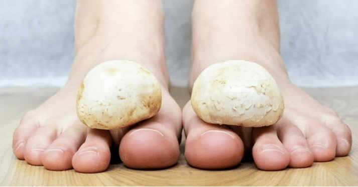 Fast treatment of fungi in the legs in the house