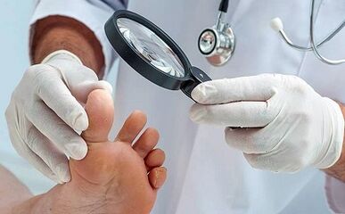 How to get rid of your nail mushroom