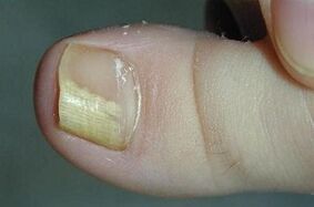 Reasons for the image of the mushroom on the thumb of the foot