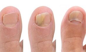 Stages of development of mushrooms in the thumb of the foot
