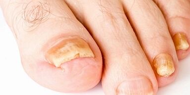 How and how to treat nail fungus
