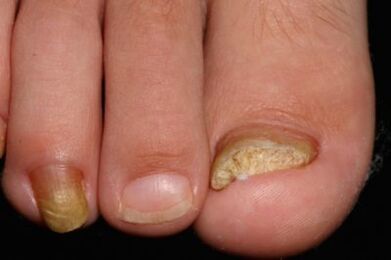 Microix of nails in feet