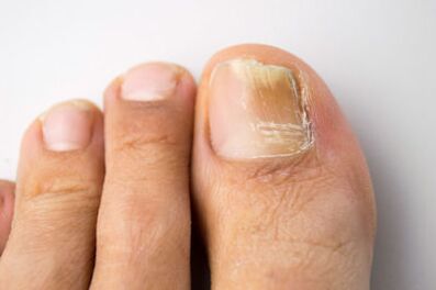 Mikosis caused by Mayan microorganisms