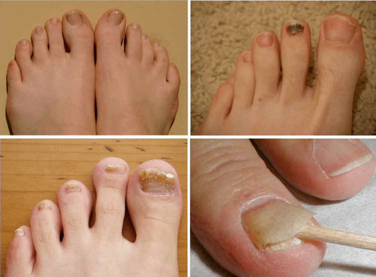 Signs of nail fungi
