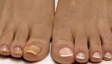 Reasons for the image of the mushroom in the nail