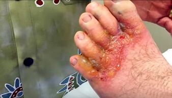 Mushroom symptoms over toes