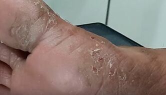 Types and forms of fungi in toes