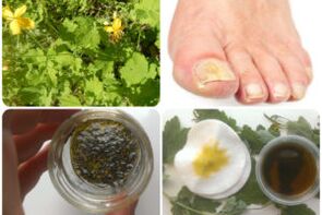 Folk remedies for nail fungus