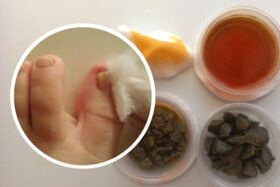 Treatment of nail fungus with folk remedies