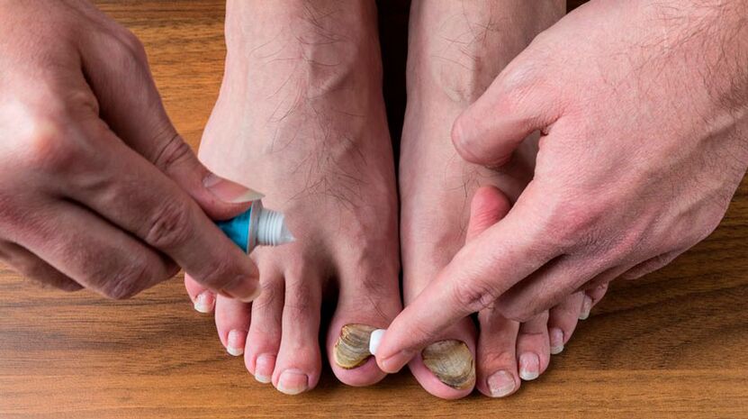 Applying an antifungal cream to the toenails to treat onychomycosis
